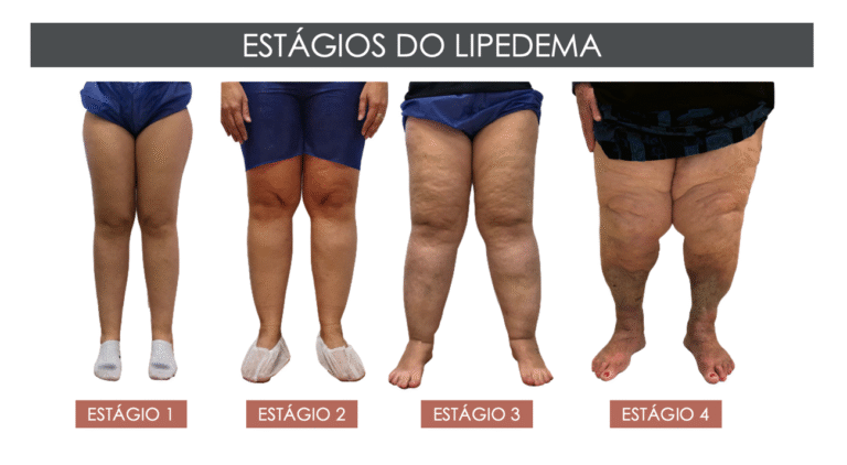 estagios-do-lipedema