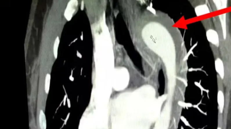 image-78 Caso raro: mulher sofre ruptura na aorta durante o sexo e sobrevive