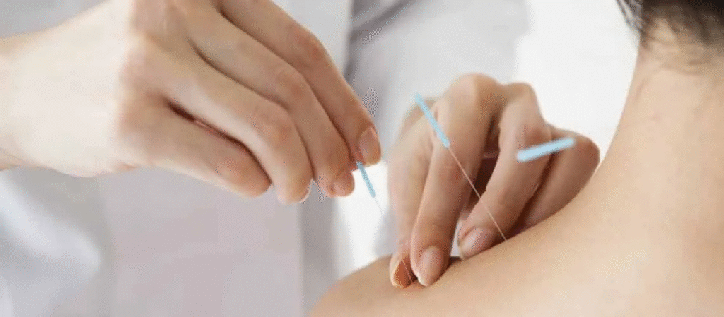 image-209-1024x449 Regulamentação da acupuntura entra em vigor com vetos do governo